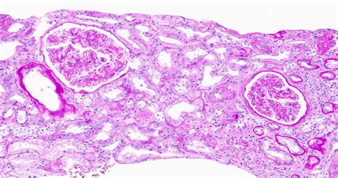 spike and dome appearance membranous nephropathy|Pathology Outlines .